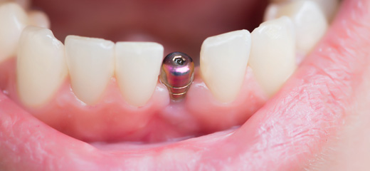 Implants