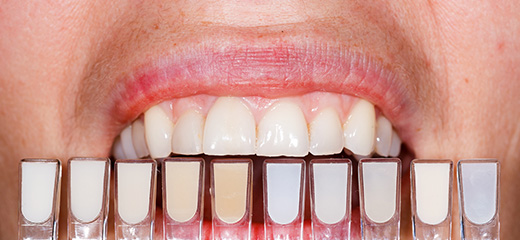 Porcelain Veneers